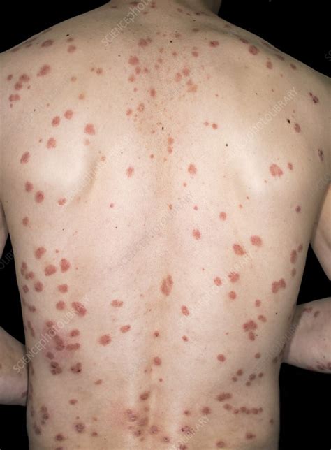 Guttate psoriasis, guttate psoriasis is a type of ...