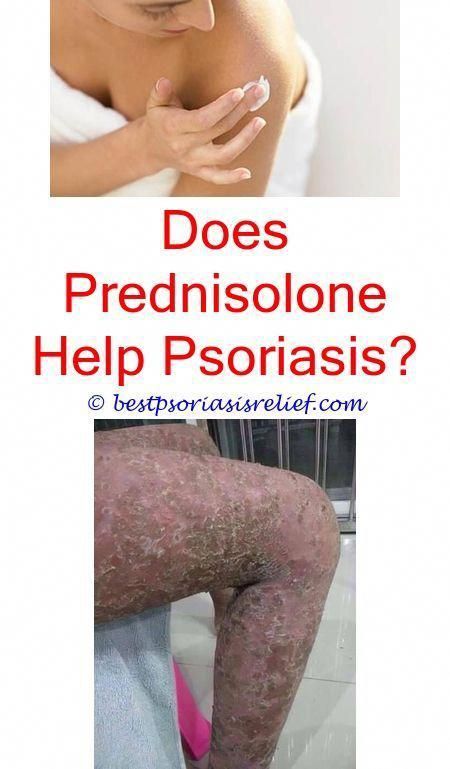 psoriasiselbow psoriasis lotion