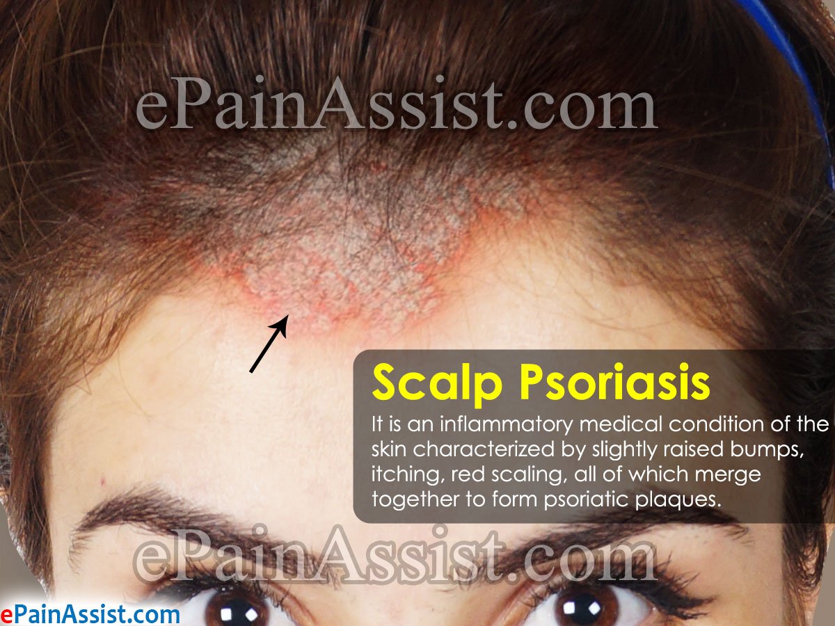 Scalp Psoriasis: Treatment, Home Remedies, Prognosis