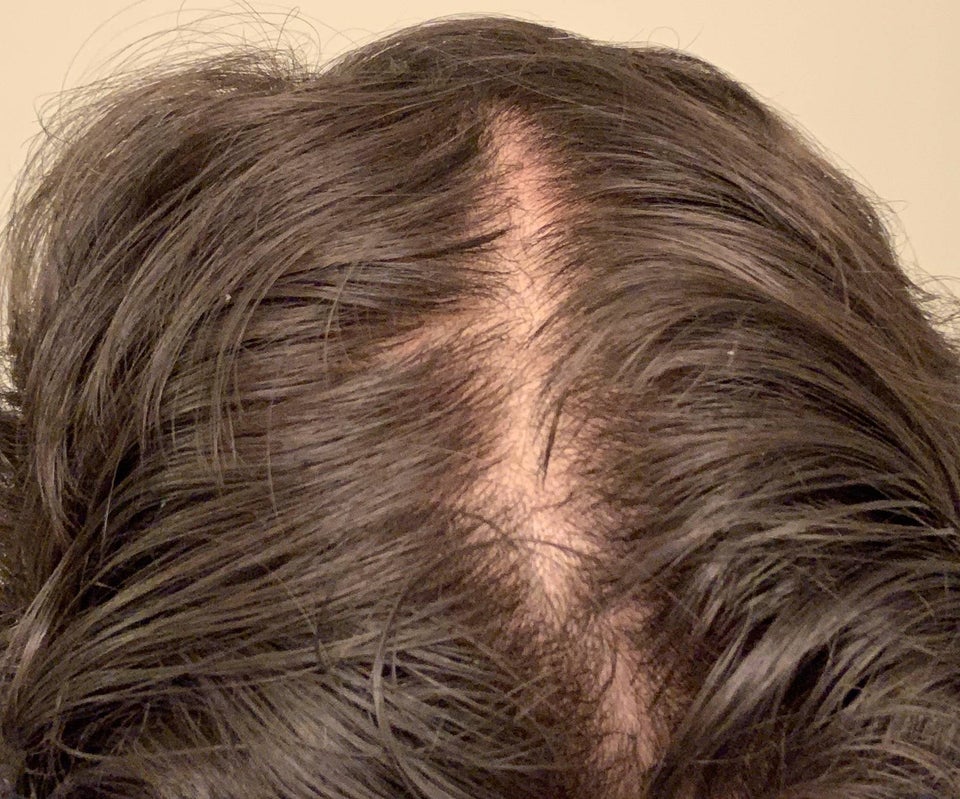 Why is my scalp easily visible? 17M : Balding